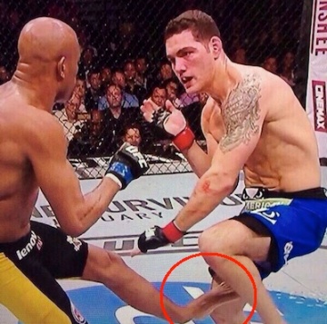 Silva broken leg